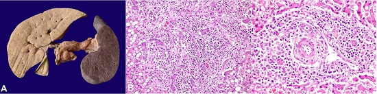 A &ndash; Gross view of the enlarged liver and spleen. B, and C &ndash; Photomicrographs of the liver. B - Cellular infiltrate within the portal tracts, and extending to the periportal areas (H&E x200); C &ndash; LC within the portal tracts causing destruction of bile ducts (H&E x400).