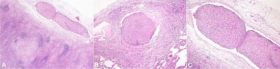 Photomicrographs of the lymph node. A, B &ndash; Lymphovascular emboli comprising of LC and accompanying cells enmeshed within fibrin (x100, B x200 respectively); C &ndash; High magnification showing the lymphovascular emboli comprising of LC (H&E x400).