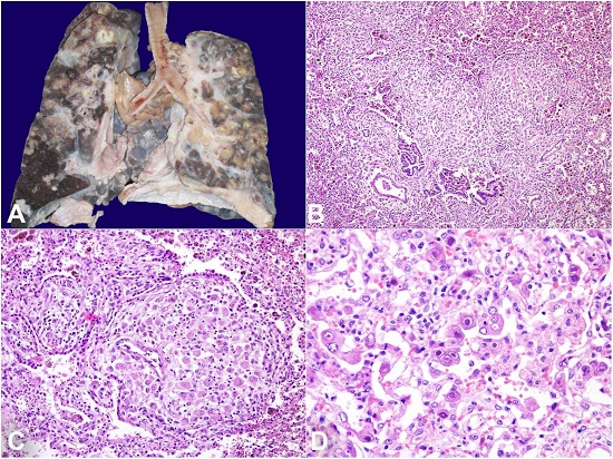 A &ndash; Gross view of the cut surface of both lungs showing nodules centered on the airways; B &ndash; Bronchiolocentric infiltrate seen within the lung parenchyma (H&E x200); C &ndash; LC infiltration causing destruction of the airways (H&E x400); D &ndash; Cytomegalovirus inclusions (CMV) seen lining the alveolar epithelial cells (H&E x400).