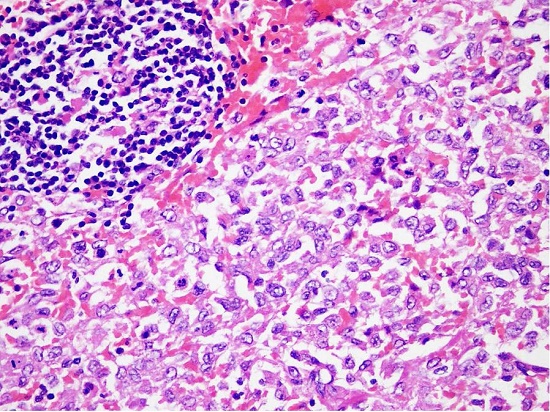 Photomicrography of the spleen showing a subtotal effacement of nodal architecture by LC and accompanying cells (H&E x200).