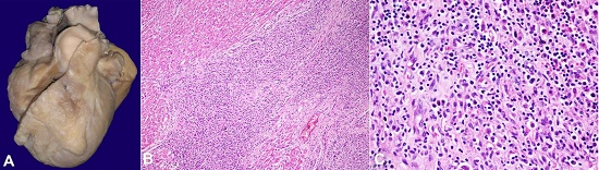 Gross view of the heart showing prominent nodular elevation on the anterior surface of right ventricle and right border; B and C Photomicrographs of the heart &ndash; A and B &ndash; depicting infiltration of ventricular wall by LC (H&E, B x200, C x400).