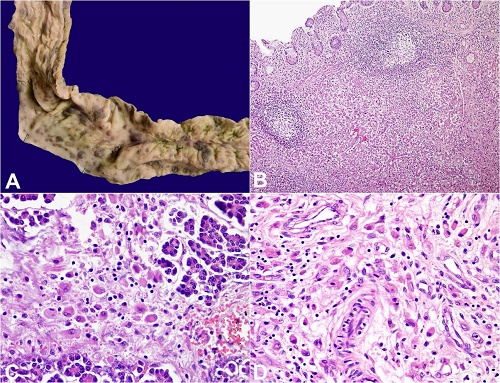 A &ndash; Gross view of the small intestine showing hemorrhagic ulcers; B &ndash; LC infiltrate expanding the lamina propria (H&E x200); C &ndash; Infiltrate within the pancreas (H&E x400); D &ndash; Infiltrate within the thymus (H&E, x400).
