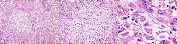 Photomicrographs of the lung showing: A &ndash; LCH granulomas mimicking tuberculosis (H&E x200); B &ndash; High magnification showing the cellular composition of the infiltrate chiefly composed of LC cells and lymphomononuclear cells (H&E x400); C &ndash; Photomicrograph in oil immersion field depicting the characteristic grooved nuclei of LC cells (H&E x1000).