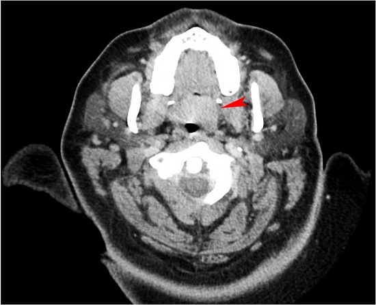 Axial contrasted-enhanced CT of the neck demonstrating mildly enhanced mass in the soft palate (red arrowhead).