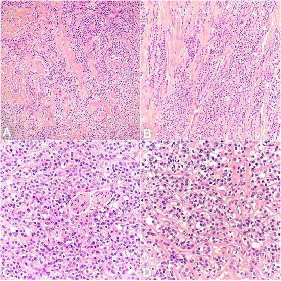 Photomicrographs of the tumor showing in A & B &ndash; combination of cords and nests of clear cells in a hyalinized background (200x, H&E); C &ndash; Prominent perineural invasion (400x, H&E); D &ndash; Prominent cytoplasmic clearing (400x, H&E).