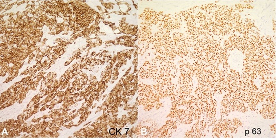 Immunohistochemical stains, strongly positive for CK7 (A, 200X) and p63 (B, 200X).