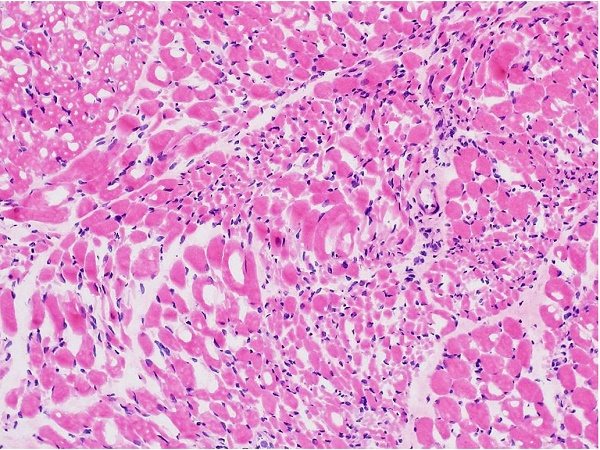 Photomicrograph of the deltoid muscle shows group atrophy of muscle fibers in the background of relatively preserved and apparently hypertrophic muscle fibers (H&E, 200x).