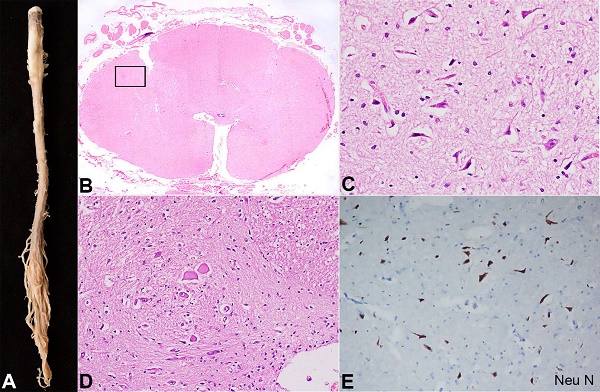 A – Gross view of the dissected spinal cord. B, C, D and E are photomicrographs of the spinal cord; B – Transverse section from the spinal cord at the thoracic level without evidence of infarct or inflammation with the rectangle denoting the ventral horn site on one side (H&E, 20x); C – Section from the area of ventral horn shows degenerated anterior motor neurons with pyknotic nuclei(H&E, 200x); D – Sections from the area of ventral horn shows swollen and pale neurons with loss of Nissl substance (H&E, 200x); E – Neu N (Clone EPR12763, 1:1000 dilution, DAKO) highlights reduced density of neurons in the ventral horn of spinal cord (200x).