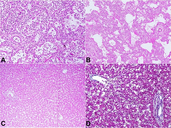 Photomicrographs of the Lung (A and B). A – Dense infiltration of alveolar spaces by polymorphs (H&E, 200x); B – Alveolar ducts lined by dense eosinophilic hyaline membrane (H&E, 200x). Photomicrographs of the liver (C and D); C – Panlobular microvesicular steatosis (H&E, 40x); D – Absence of fibrosis and accentuates the panacinar microvesicular steatosis (Masson Trichrome, 100x).