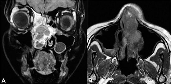 Fascial MRI &ndash; A &ndash; coronal view of T1 weighted image showing lobulated polypoidal lesion arising from the nasal septum measuring 4.5 X 3 cm causing occlusion of the right nasal cavity with erosion of nasal septum and ethmoidal air cells; B &ndash; Axial view of T1 weighted image showing polypoidal lesion in the right nasal septum.