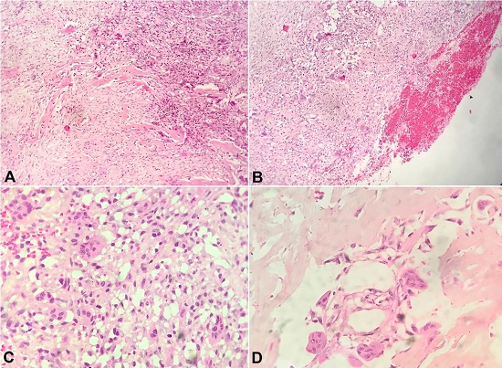 Photomicrographs of the tumor (case 1). A and B show the osteoclast-like giant cells in the spindled stroma with osteoid formation along with cystic cavity lined by fibro collagenous tissue and osteoclastic giant cells filled with blood (H&E, 200X); C and D show osteoclast-like giant cells in the spindle cell stroma with osteoid formation (H&E, 400X).