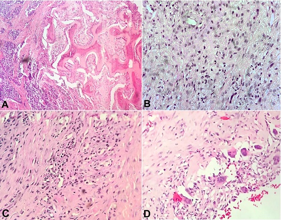 Photomicrographs of the tumor (case 2). A and B show fibro collagenous tissue with plump spindle cells, fibroblasts, and multiple foamy histiocytes. Occasional foreign body giant cell and collection of mixed inflammatory cells, mostly of neutrophils, lymphocytes, and few plasma cells are seen. (H&E, 200X); C and D show fibro collagenous tissue with plump spindle cells and foamy histiocytes along with giant cells (H&E, 400X).