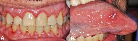 Oral examination. A – Generalized gingival enlargement associated with marginal petechiae; B – Right lateral border of the tongue showing a hardened and ulcerated lesion.