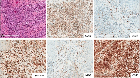 Photomicrographs of the tongue showing in A – poorly-differentiated hematolymphoid cells, with the presence of eosinophilic and neutrophilic cells (H&E); and Immunohistochemistry (DAB; 200x). Positive for CD45, CD68, lysozyme, MPO, and CD15.