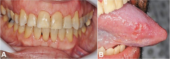 Oral examination. A – Clinical appearance of the gingiva after the first cycle of chemotherapy; B – Clinical appearance of the tongue after the first cycle of chemotherapy and biopsy.