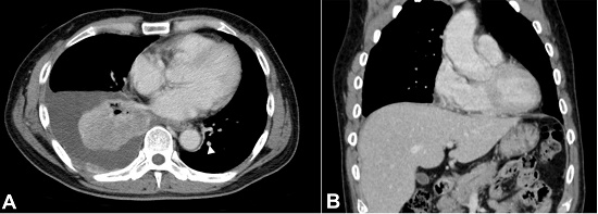 Chest CT at the initial diagnosis, showing in A &ndash; A poorly-defined 6 cm tumor with surrounding atelectasis, and pleural effusion, in the right lower pulmonary lobe, and a contralateral metastasis (arrowhead); B &ndash; Note the absence of hepatic involvement.