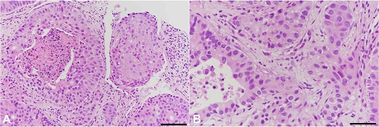 Photomicrographs of the needle biopsy. A &ndash; The neoplastic cells forming solid structures with central necrosis. (H&E, Bar: 100 μm); B &ndash; The neoplastic cells with abundant eosinophilic cytoplasm and round nuclei (H&E, Bar: 50 μm)