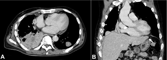 Chest CT obtained at 6 months after diagnosis showing in A &ndash; increasing size of the tumors volumes of both lungs increased. B &ndash; A whole-body CT scan revealed a nodule (arrow) in the liver.