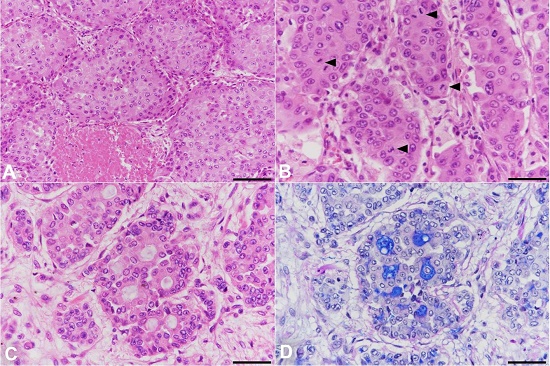 Photomicrographs of the right lung tumor. A &ndash; The neoplastic cells are in solid nests and trabecular structures with central necrosis. (H&E, Bar: 100 μm); B &ndash; The neoplastic cells have abundant eosinophilic cytoplasm and round nuclei. Several mitotic figures are seen (arrowheads) (H&E, Bar: 50 μm), C &ndash; The neoplastic cells also form acinar structures, (H&E, Bar: 50 μm); D &ndash; Acidic mucin production is in the acinar lumina. Periodic acid Schiff and Alcian blue staining were performed (Bar: 50 μm).