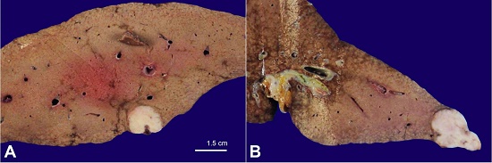 Gross findings of the cut surface of the liver. A &ndash; Nodular lesion in the right lobe of the liver. The nodule was well circumscribed and did not exhibit capsulation; B &ndash; Note a similar nodule in the left hepatic lobe.