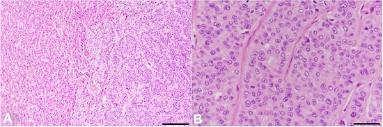 Photomicrographs of the hepatic tumor. A &ndash; The transition area between the uninvolved hepatic tissue (left side) and hepatoid adenocarcinoma (right side) (H&E, Bar: 200 μm); B &ndash; The neoplastic cells are displayed in nested structures mimicking a hepatocellular carcinoma (H&E, Bar: 50 μm).