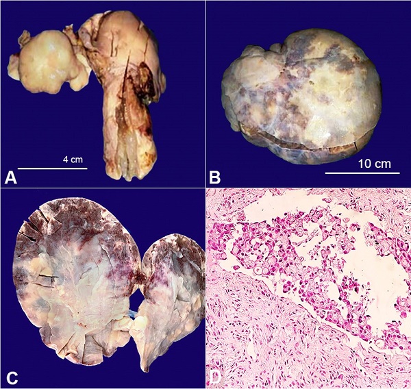 The external surface of both A – the right ovary and B – the left ovary was bosselated; C – The cut surface of the left ovary was solid, whitish with foci of congestion; D – Photomicrograph of the ovary showing signet ring cell adenocarcinoma (H&E, 400X).