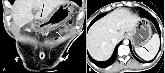 Abdominal CT scan: Emphysematous Gastritis. A &ndash; Coronal plane of the thickened edematous gastric wall (white arrow) and gas noted in a mural vein (black arrow); B &ndash; Axial image demonstrates gas in the mucosa of the gastric wall (white arrows) and in a mural vein (black arrow).