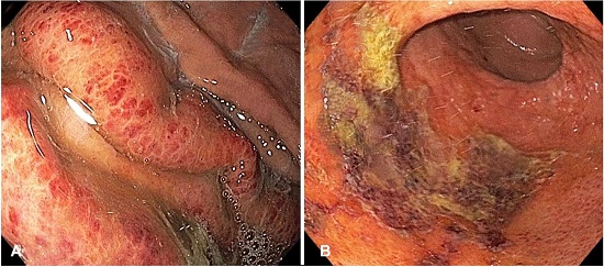 Endoscopic view of the stomach: A &ndash; severely erythematous mucosa; B &ndash; Diffuse superficial ulceration and exudates with evidence of recent hemorrhage in the gastric body and antrum