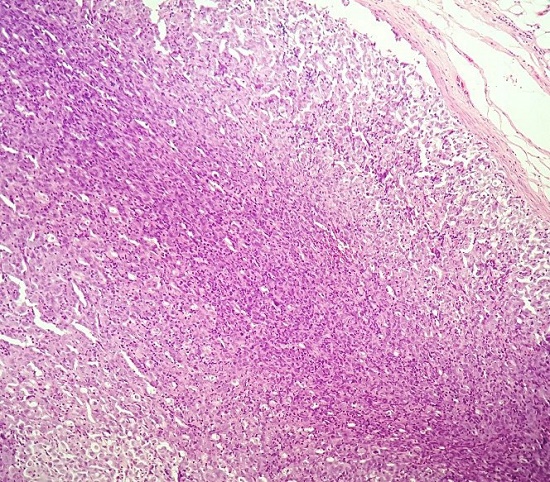 Photomicrograph of the lymph node showing complete effacement of the architecture by diffuse proliferation of large pleomorphic tumor cells (H&E, X200).