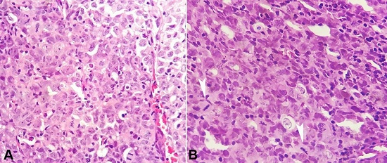 A and B – Photomicrograph of the lymph node showing large tumor cells with multilobate nuclei, prominent nucleoli and exhibiting atypical mitotic figures (arrowheads) (H&E, 400X).