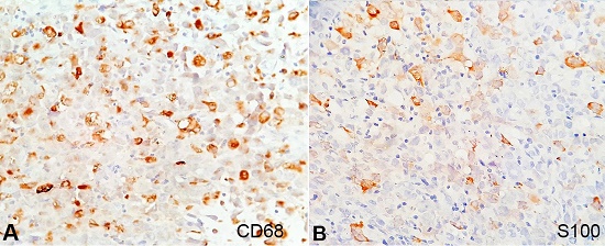Photomicrograph of the lymph node showing positivity for CD68 (A), and S100 (B), (400X).