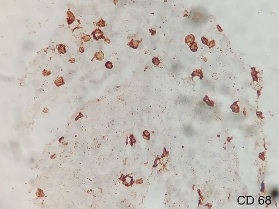 Photomicrograph of the bone marrow showing positivity for CD68 (400X).