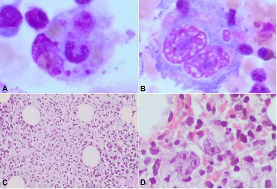 Photomicrograph of the bone marrow. A &ndash; Bone marrow aspirate demonstrated hemophagocytosis, which is compatible with the clinical aspects of the patient, and it is possible in the neoplastic context, for example, HL (Giemsa, 1000x); B &ndash; Cytological aspect Reed-Sternberg cell in the bone marrow aspirate (Giemsa, 1000x); C &ndash; there is a granulomatous aspect. D there are some atypical cells in the periphery of this granulomatous pattern. These atypical cells have morphological aspects of Reed-Sternberg cells and Hodgkin cells [C (H&E, 400x) and D (H&E, 400x)].