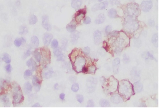 Photomicrograph of the bone marrow. Positivity to CD30 confirmed the diagnosis of HL (400x).