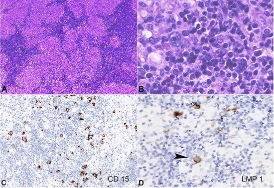 Photomicrograph of the lymph node. A &ndash; Lymph node altered architecture. There are many granulomas in a sarcoid-like aspect. However, in the granulomas&rsquo; periphery, there are some atypical cells that are presented in the image (H&E, 200x); B &ndash; Presence of Hodgkin cells intermingled with the lymphocytes (H&E, 400x); C &ndash; positive reaction to CD15 (400X); D &ndash; positive reaction to LMP-1/EBV (arrowhead) (400X).