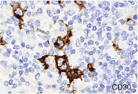 Photomicrograph of the lymph node. Positive reaction to CD 30 (400X).