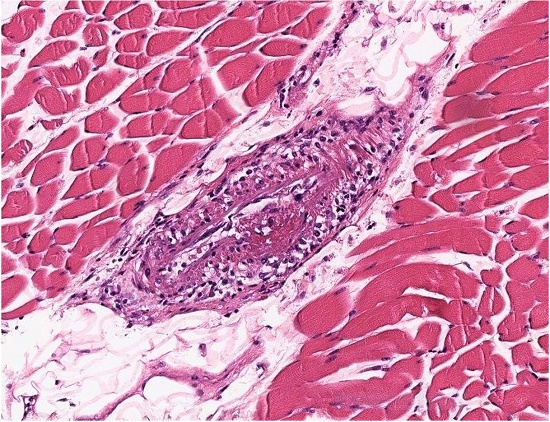 Necrotizing vasculitis with fibrinoid degeneration (&ldquo;fibrinoid necrosis&rdquo;) of a medium artery within psoas muscle (H&E, 90X).
