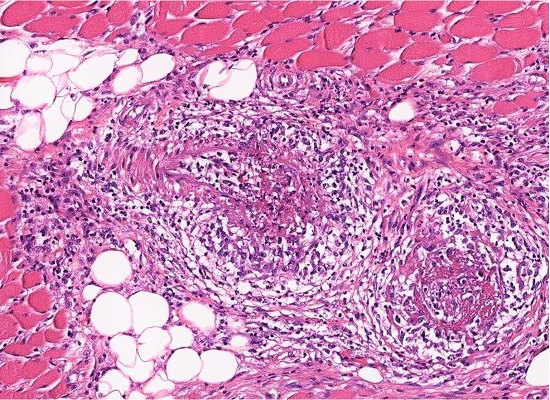 Severe necrotizing vasculitis obliterating a medium artery within psoas muscle (H&E, 90X).