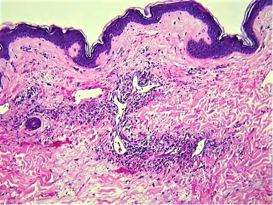 Leukocytoclastic vasculitis, with extensive basophilic debris (&ldquo;nuclear dust&rdquo;) around involved capillaries and venules in the skin (H&E, 100X).