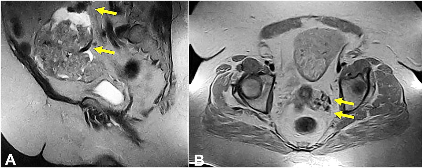 Pelvic MRI - T2 weighed images. A &ndash; Sagittal view of a pedunculated right uterine mass with enlarged gonadal artery and vein (arrows); B &ndash; Axial view of the dilated left uterine artery and vein with tortuous vessels surrounding cervix (arrows).