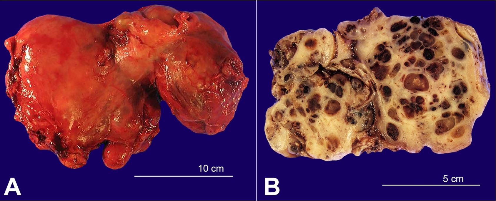 Gross view of the A &ndash; Fresh total hysterectomy mass showing enlarged and deformed uterus; B &ndash; A cut surface through formalin-fixed specimen displaying multi-locular nature of the mass some containing clotted blood (dark loculi).