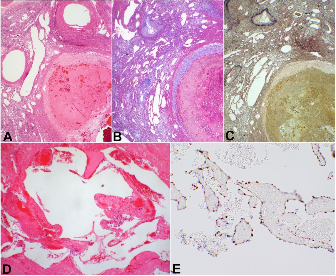 Photomicrographs of the lesion. A &ndash; Hematoxylin & eosin (H&E) stain showing an abnormally dilated blood vessel filled with blood-clot (right lower quadrant). There are blood vessels of different size and wall-thickness throughout the field; B &ndash; Masson trichrome stain of the same area, as in the H&E photomicrograph, showing the proliferated blood vessels in a fibro-muscular background; C &ndash; Verhoeff elastic stain displaying the vessels including arteries and venules with abrupt changes in thickness of the medial, elastic layers of vessels, and vascular luminal sizes; D &ndash; H&E stain showing intravascular papillary endothelial hyperplasia (Masson bodies). Background is significant for hemorrhage and congestion; E &ndash; ERG immunohistochemical stain shows the endothelial cells covering the Masson bodies (A-D: 2x, E: 10x objectives).