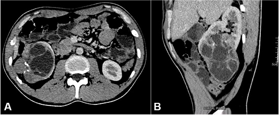 Abdominal contrasted CT showing in A – axial plane - and in B – sagittal plane – a 9.7 X 8.2 X 7.7 cm complex solid and cystic mass in the mid and lower pole of the right kidney with few foci of punctate and linear calcification.