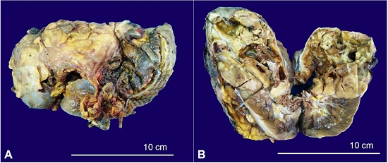 Gross view of the surgical specimen showing in A and B a solid, and cystic mass occupying two-thirds of the renal parenchyma.