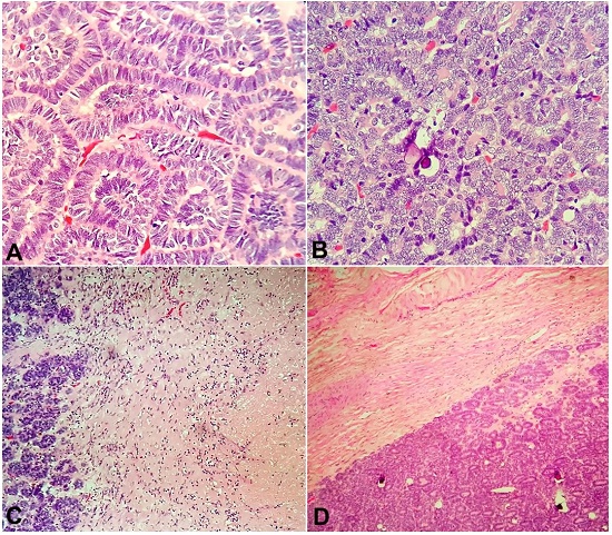 Photomicrographs of the tumor showing A and B – tightly packed acini and papillary structures with psammoma bodies (H&E, 400X); C – area of necrosis (H&E, 100X); D – tumor with pushing margin (H&E; 200X).