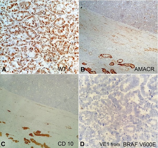 Photomicrographs of the tumor showing in: A – positive reaction of the tumor cells for WT1 (400X); B – negativity of the tumor cells to AMACR, but positivity in the normal renal tubules (200X); C – negativity of the tumor cells to CD10, but positivity in the normal renal tubules (200X); D – negative reaction of the tumor cells to VE1 protein (400X).