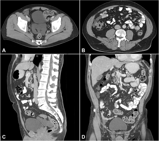 Abdominal contrast-enhanced CT scan of BMPM. A – Axial Post-Contrast CT demonstrating cystic lesion posterior to the urinary bladder; B – Axial Post-Contrast CT demonstrating cystic lesion in the right para-colic gutter; C – Sagittal Post-Contrast CT demonstrating cystic lesion posterior to the urinary bladder; D – Coronal Post-Contrast CT demonstrating cystic lesion in the right para-colic gutter