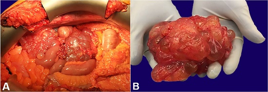Intraoperative images showing multicystic, grapelike masses.
