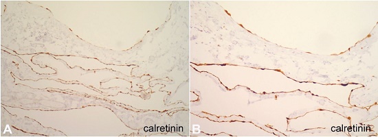 Photomicrograph of the surgical specimen showing in A and B – Calretinin immunohistochemical staining (×400) reveals a positive reaction.
