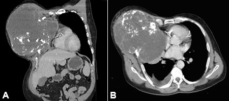 Preoperative computed tomography scan A &ndash; coronal and B &ndash; axial planes: chondrosarcoma&rsquo;s characteristic findings (lobulated mass with calcifications), with extensive destruction of the right ribs and compression of the mediastinum structures, heart, and right lung.